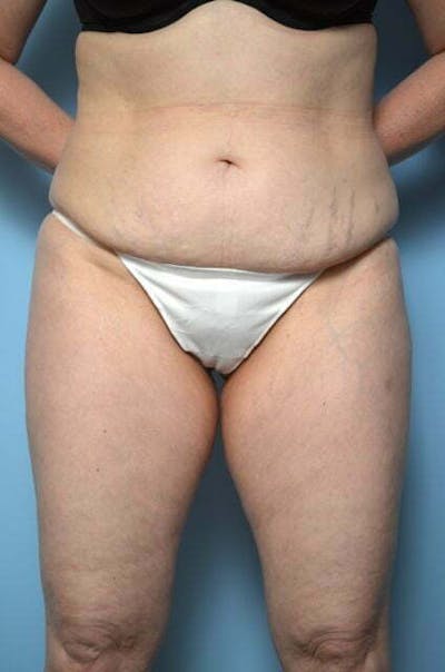 Liposuction Before & After Gallery - Patient 108637 - Image 1
