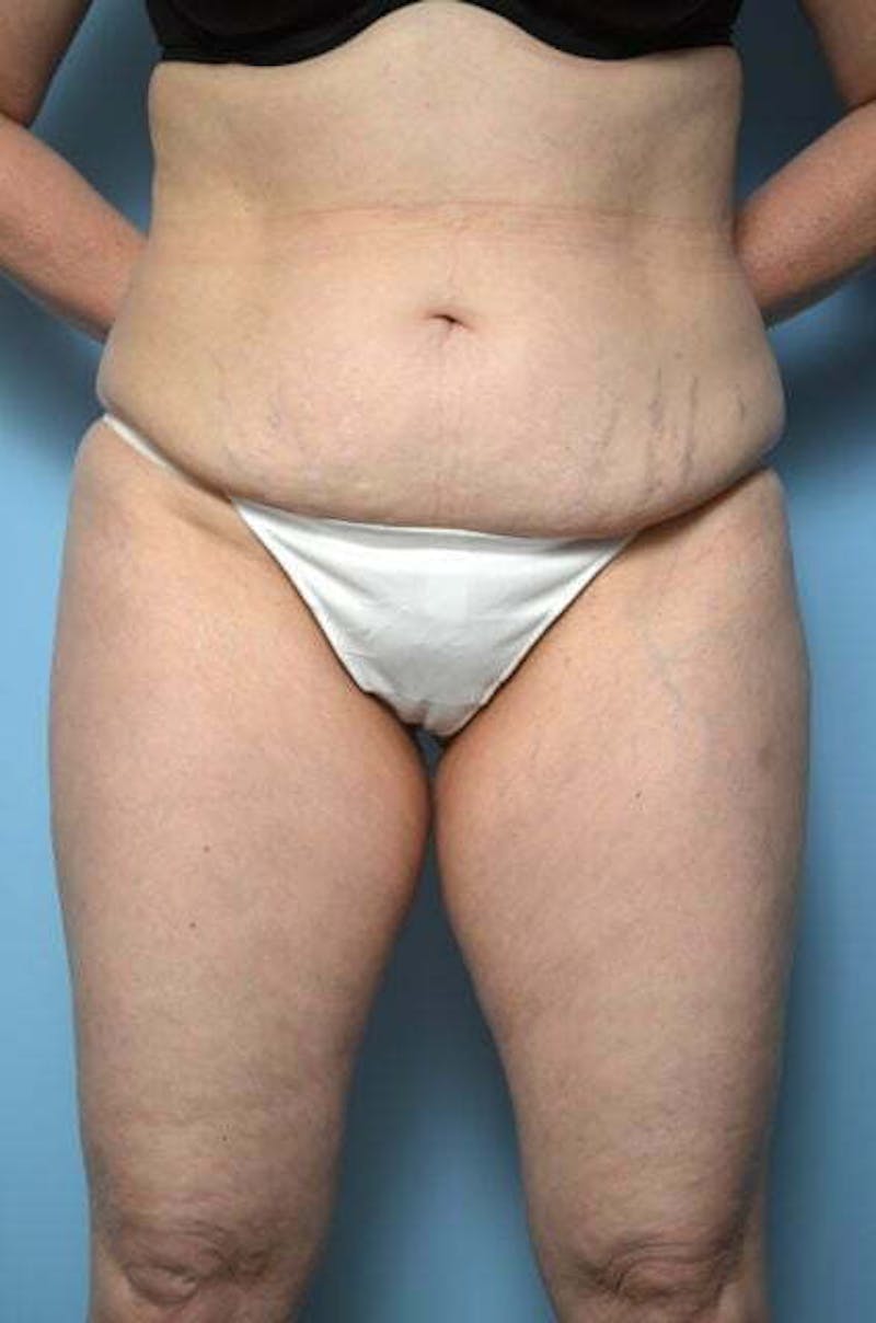 Liposuction Before & After Gallery - Patient 108637 - Image 1