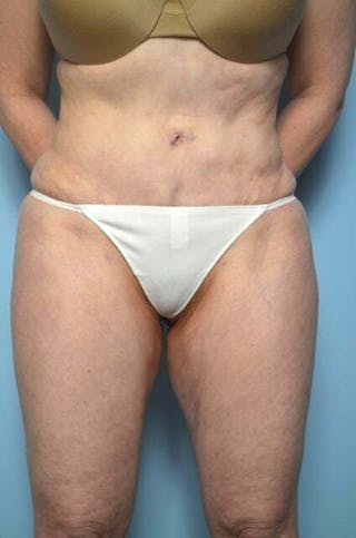 Tummy Tuck Before & After Gallery - Patient 353606 - Image 2