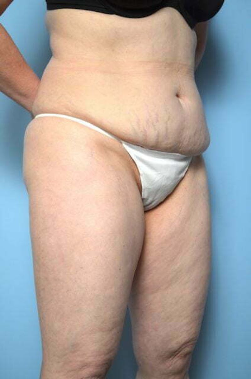 Liposuction Before & After Gallery - Patient 108637 - Image 3