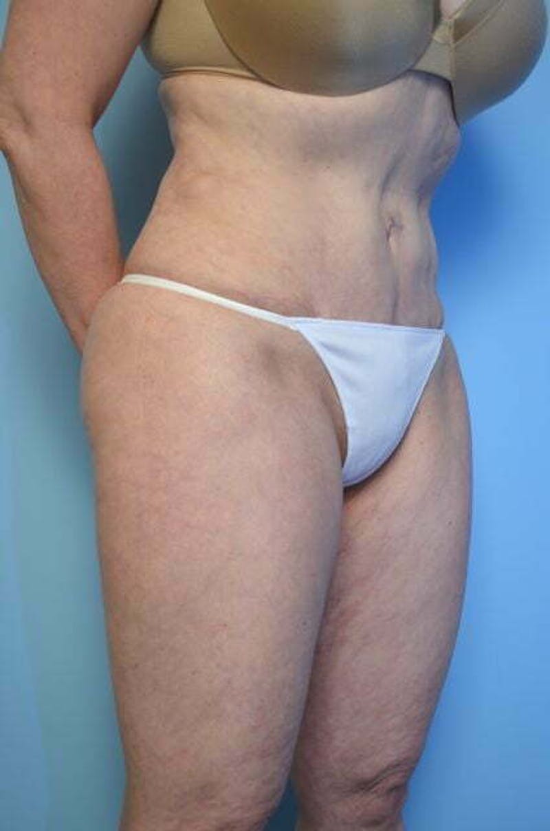 Liposuction Before & After Gallery - Patient 108637 - Image 4