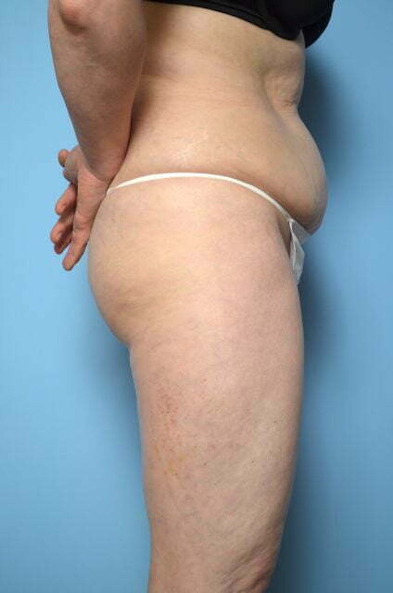 Liposuction Before & After Gallery - Patient 108637 - Image 5