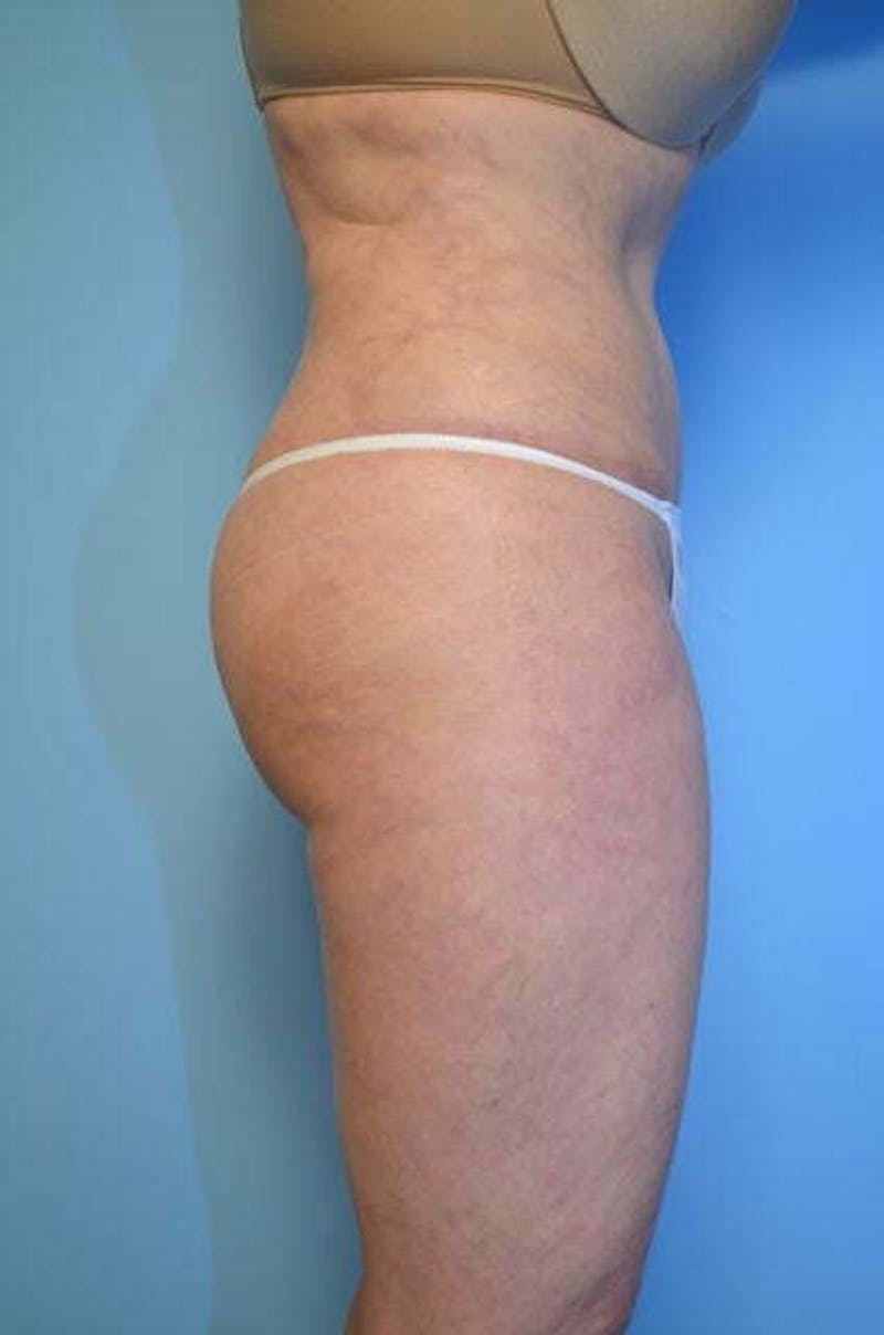 Liposuction Before & After Gallery - Patient 108637 - Image 6