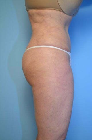 Tummy Tuck Before & After Gallery - Patient 353606 - Image 6