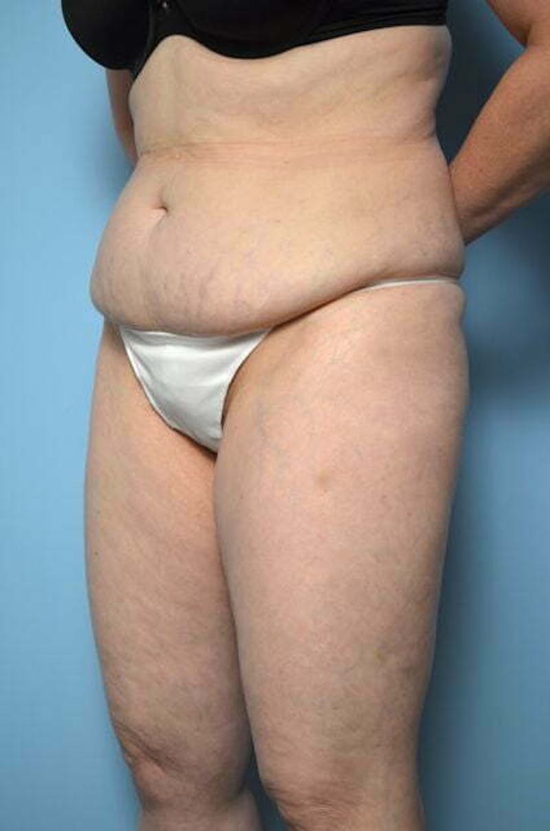 Liposuction Before & After Gallery - Patient 108637 - Image 7
