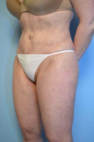 Tummy Tuck Before & After Gallery - Patient 353606 - Image 8