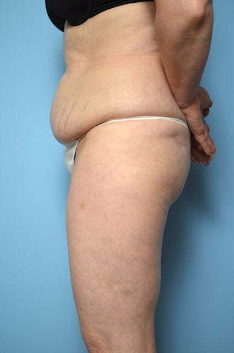 Liposuction Before & After Gallery - Patient 108637 - Image 9