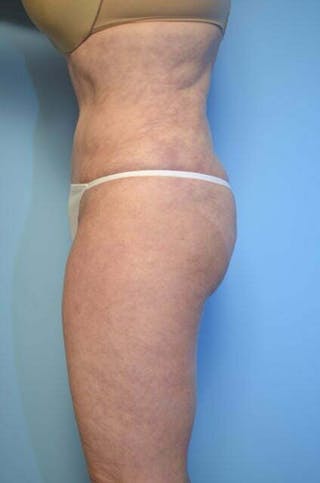 Tummy Tuck Before & After Gallery - Patient 353606 - Image 10