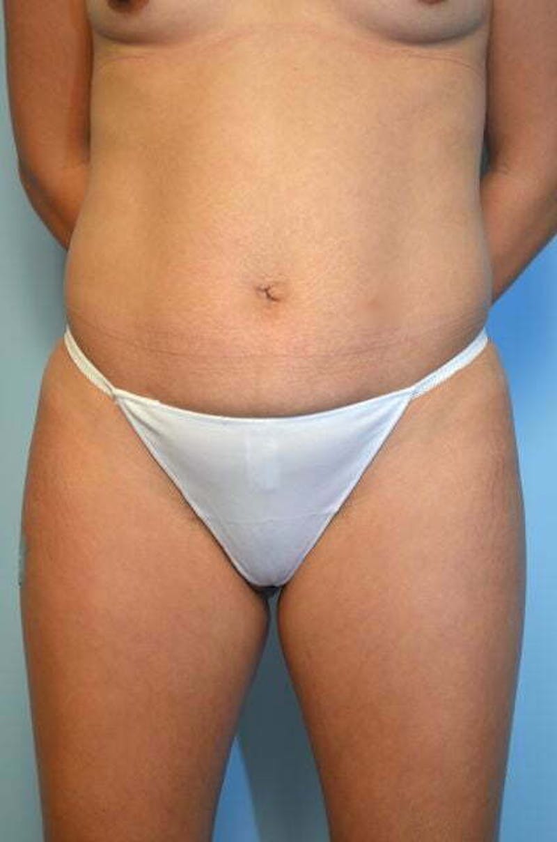 Tummy Tuck Before & After Gallery - Patient 287119 - Image 1