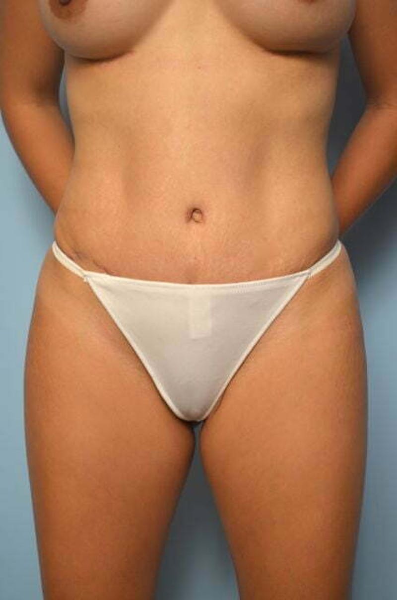 Tummy Tuck Before & After Gallery - Patient 287119 - Image 2