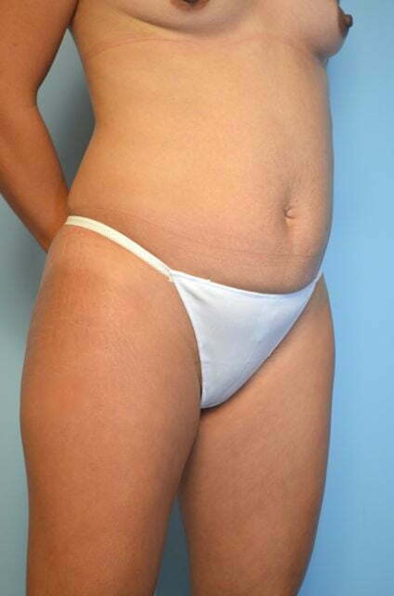 Tummy Tuck Before & After Gallery - Patient 287119 - Image 3