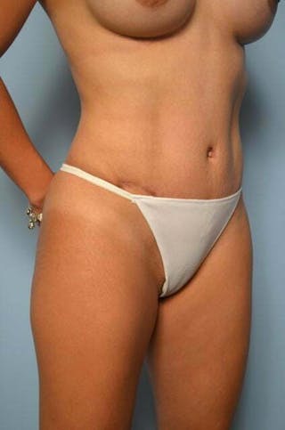 Tummy Tuck Before & After Gallery - Patient 287119 - Image 4