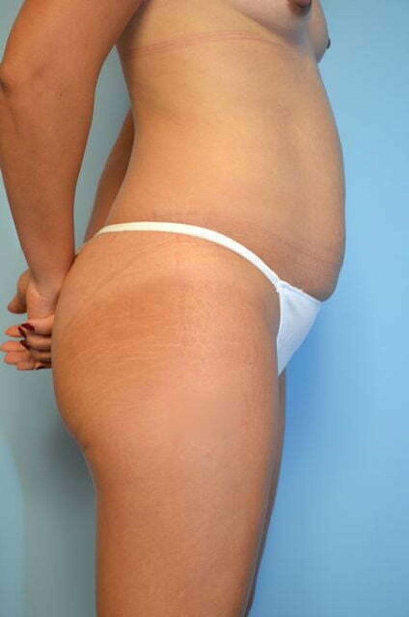 Tummy Tuck Before & After Gallery - Patient 287119 - Image 5