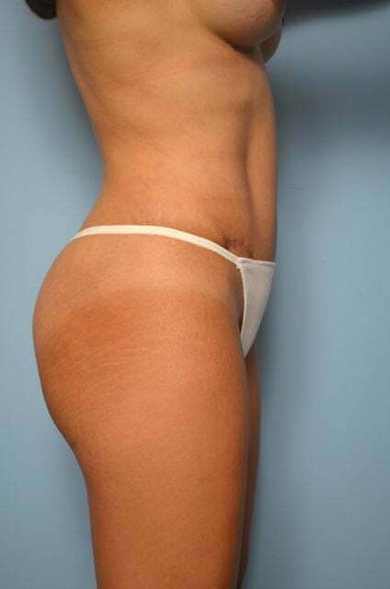 Tummy Tuck Before & After Gallery - Patient 287119 - Image 6