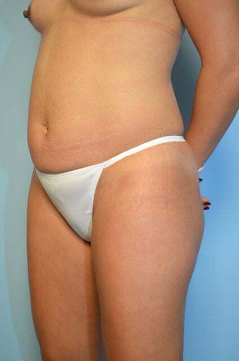 Tummy Tuck Before & After Gallery - Patient 287119 - Image 7