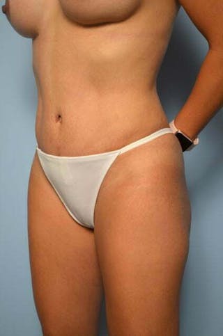 Tummy Tuck Before & After Gallery - Patient 287119 - Image 8