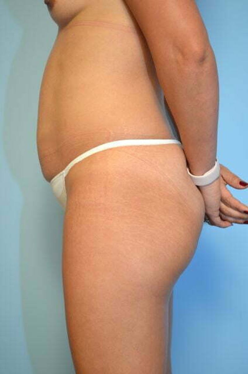 Tummy Tuck Before & After Gallery - Patient 287119 - Image 9