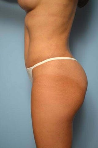Tummy Tuck Before & After Gallery - Patient 287119 - Image 10