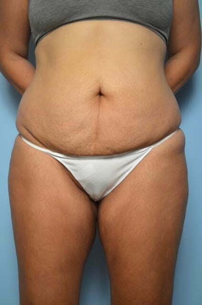 Liposuction Before & After Gallery - Patient 422203 - Image 1