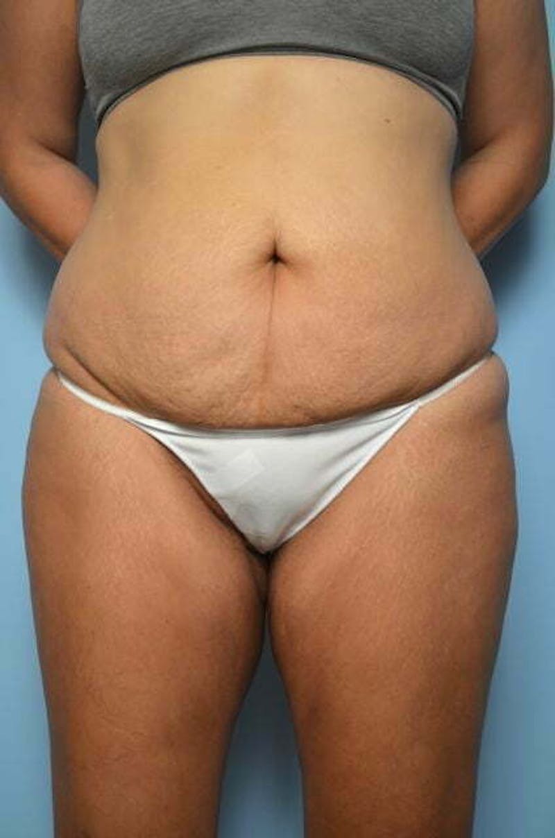 Tummy Tuck Before & After Gallery - Patient 213992 - Image 1