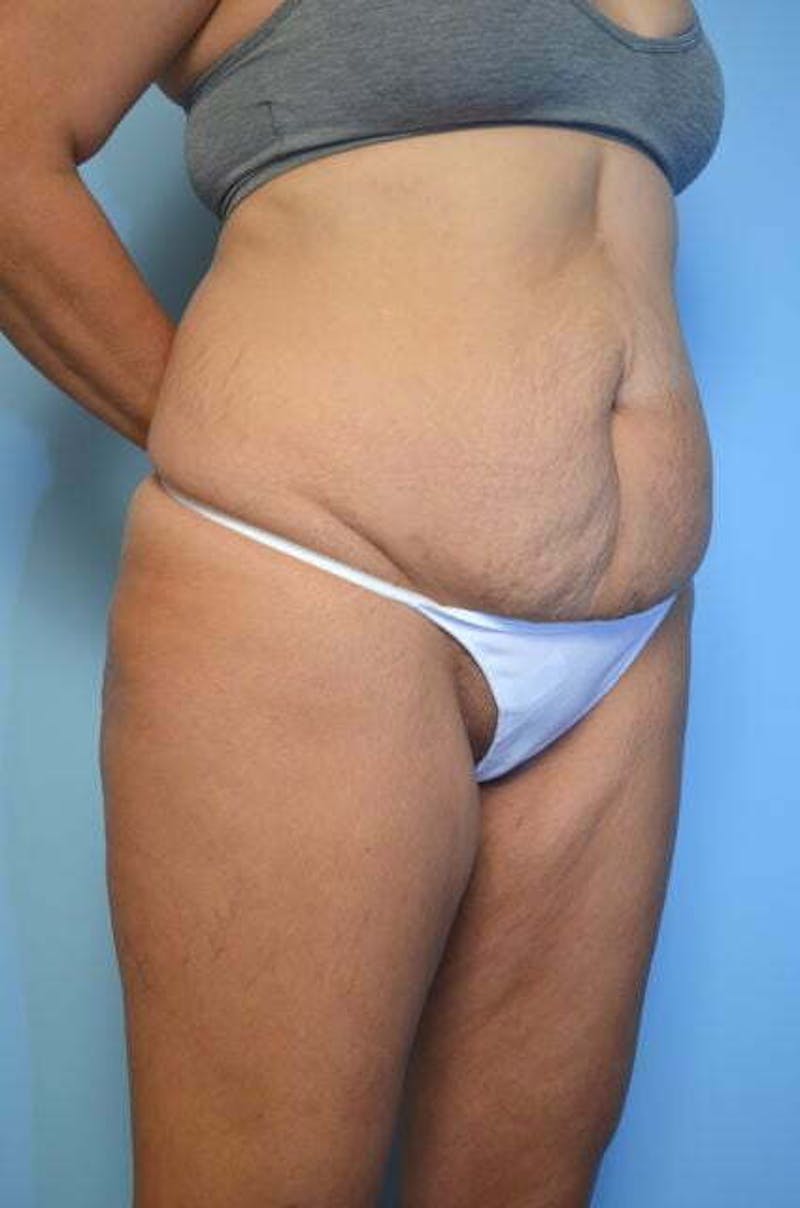 Tummy Tuck Before & After Gallery - Patient 213992 - Image 3