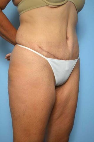 Liposuction Before & After Gallery - Patient 422203 - Image 4