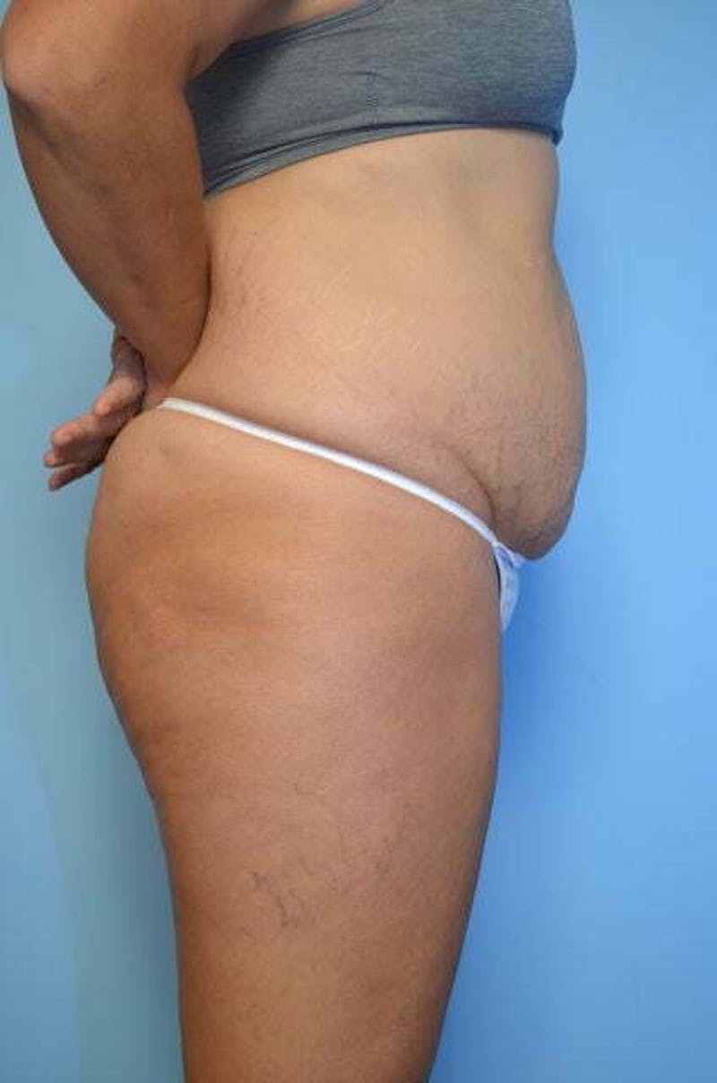 Tummy Tuck Before & After Gallery - Patient 213992 - Image 5