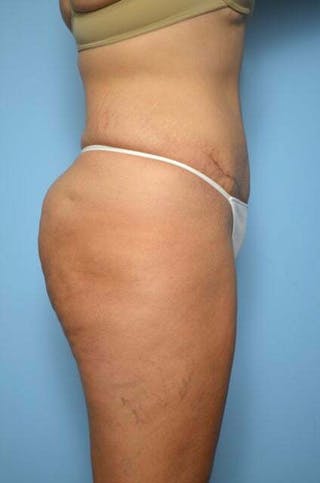 Liposuction Before & After Gallery - Patient 422203 - Image 6