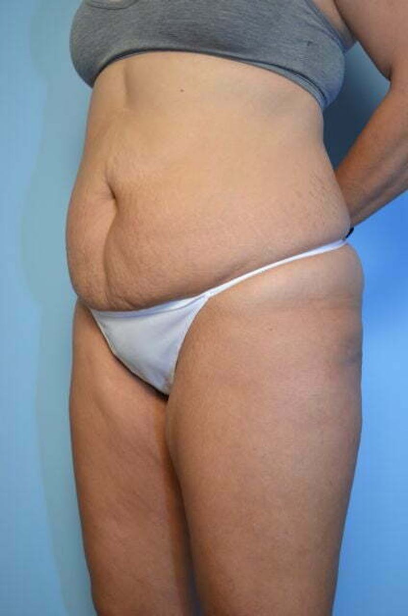 Tummy Tuck Before & After Gallery - Patient 213992 - Image 7
