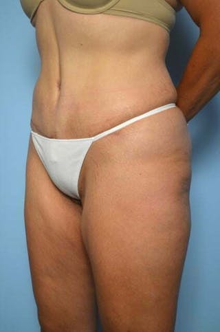 Liposuction Before & After Gallery - Patient 422203 - Image 8