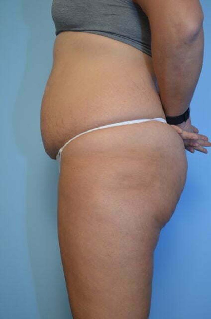 Tummy Tuck Before & After Gallery - Patient 213992 - Image 9