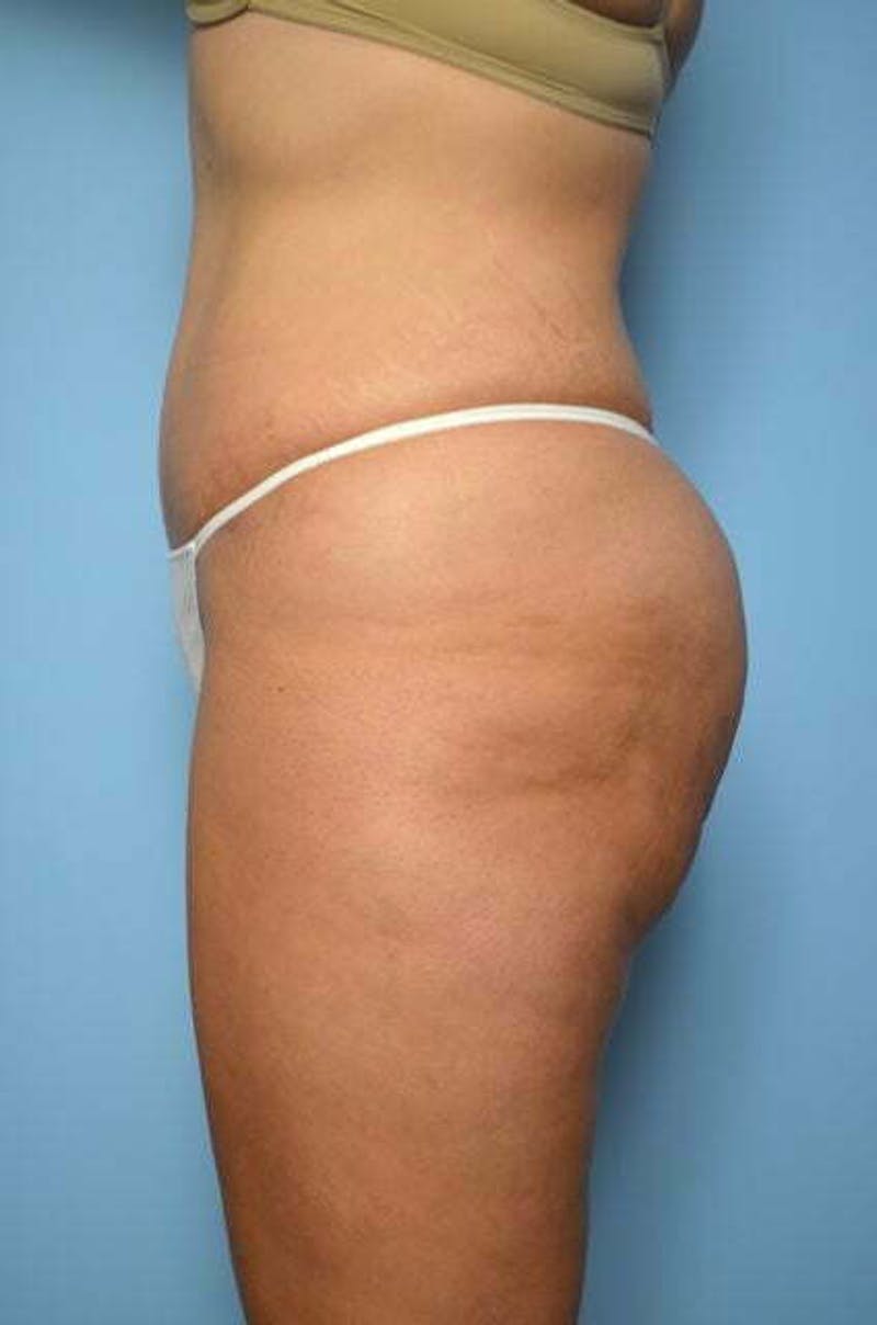 Tummy Tuck Before & After Gallery - Patient 213992 - Image 10