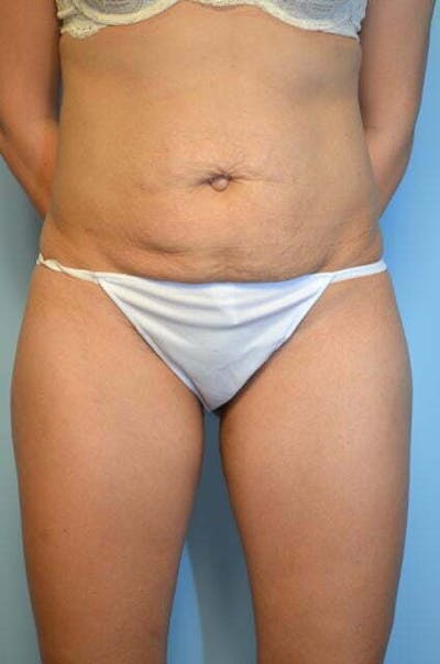 Tummy Tuck Before & After Gallery - Patient 772532 - Image 1