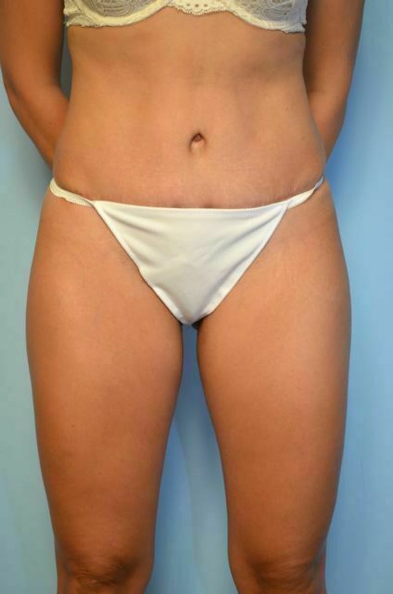 Tummy Tuck Before & After Gallery - Patient 772532 - Image 2