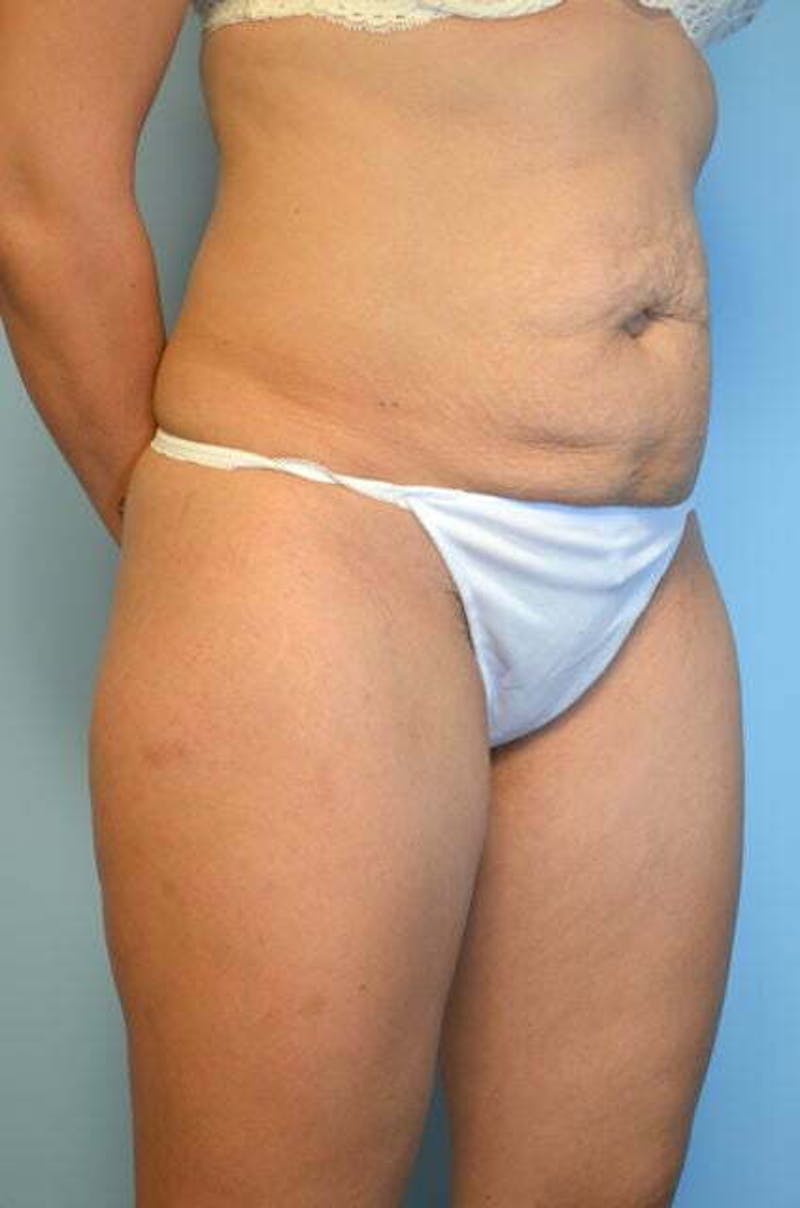 Tummy Tuck Before & After Gallery - Patient 772532 - Image 3