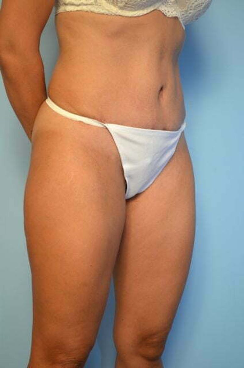 Tummy Tuck Before & After Gallery - Patient 772532 - Image 4