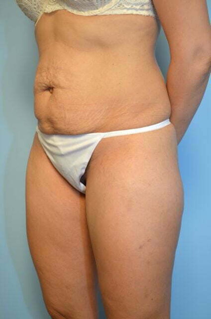 Tummy Tuck Before & After Gallery - Patient 772532 - Image 7