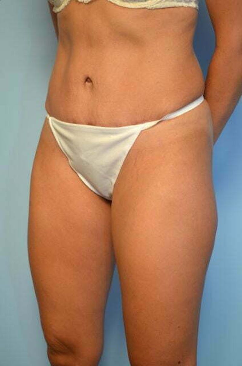 Tummy Tuck Before & After Gallery - Patient 772532 - Image 8