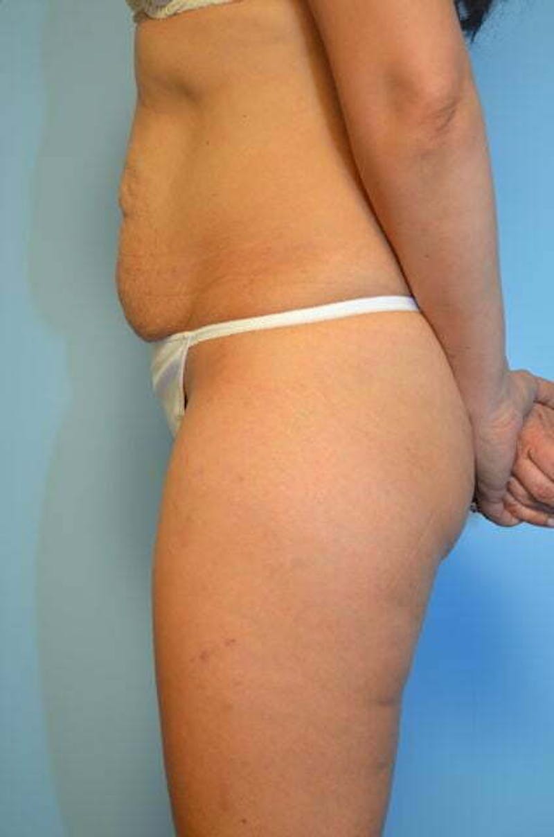 Tummy Tuck Before & After Gallery - Patient 772532 - Image 9