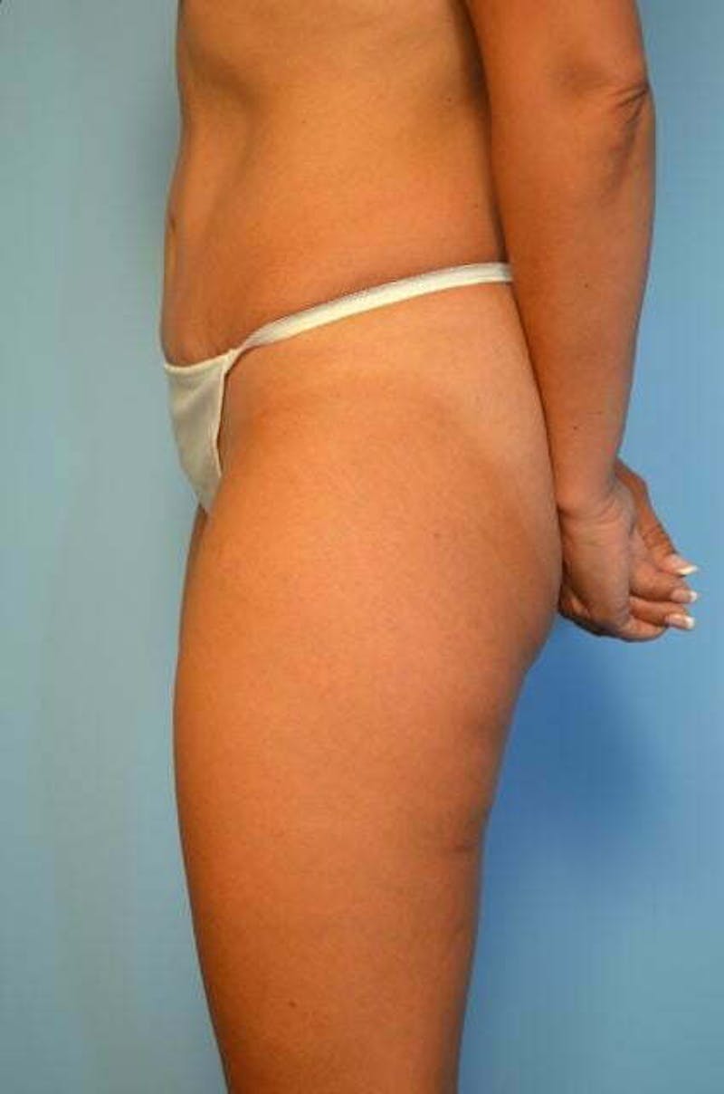 Tummy Tuck Before & After Gallery - Patient 772532 - Image 10