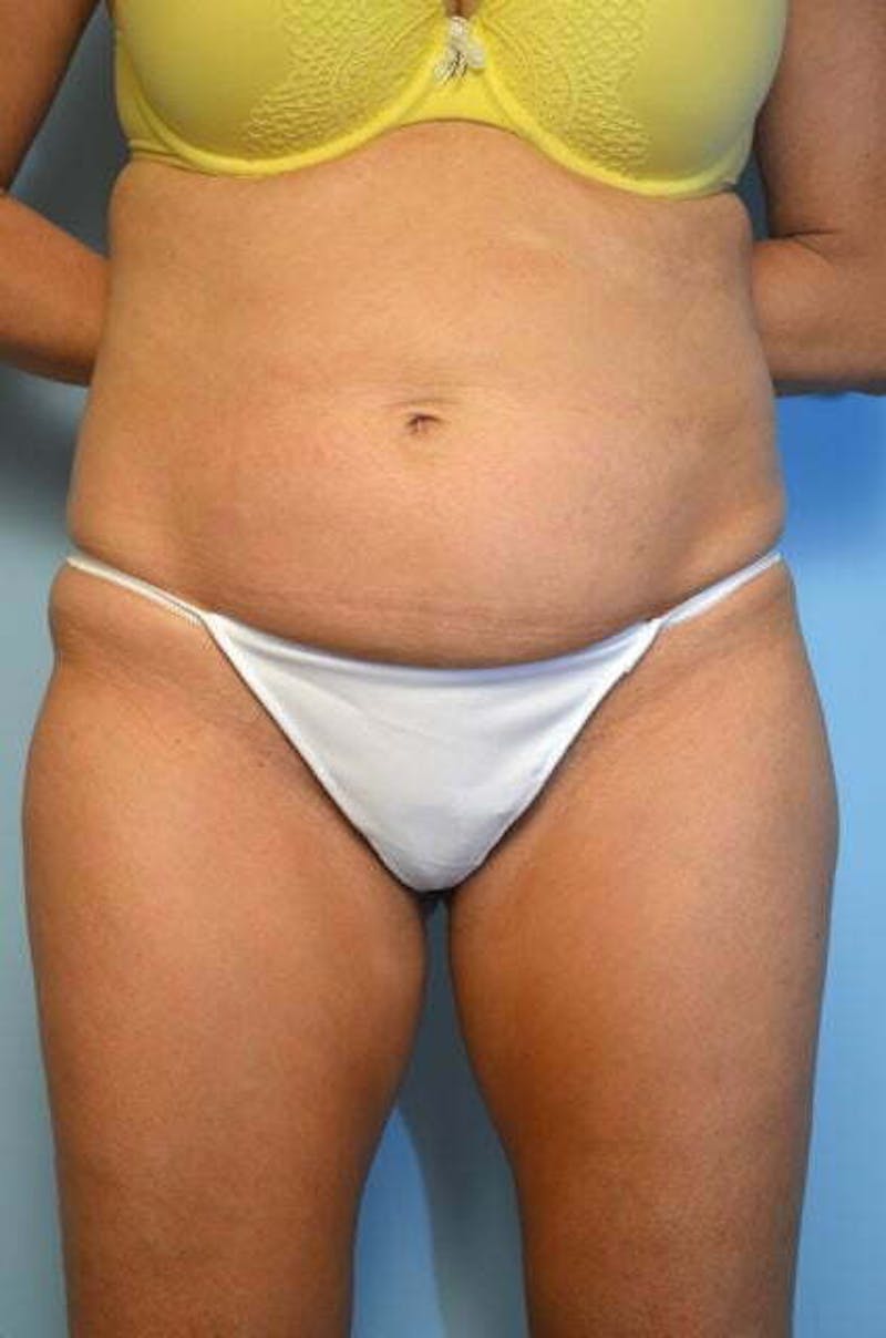 Tummy Tuck Before & After Gallery - Patient 346349 - Image 1