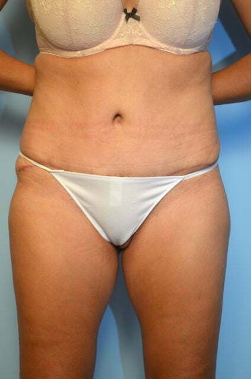 Tummy Tuck Before & After Gallery - Patient 346349 - Image 2