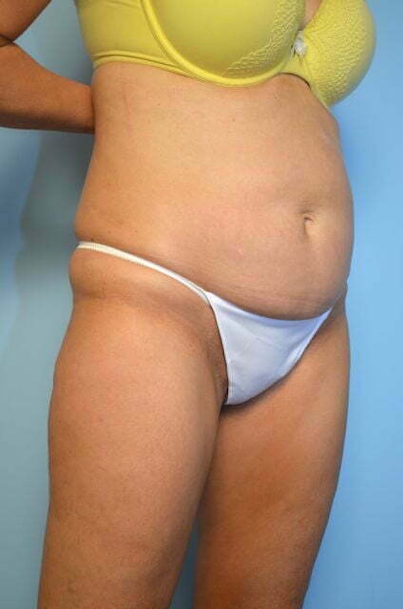 Tummy Tuck Before & After Gallery - Patient 346349 - Image 3