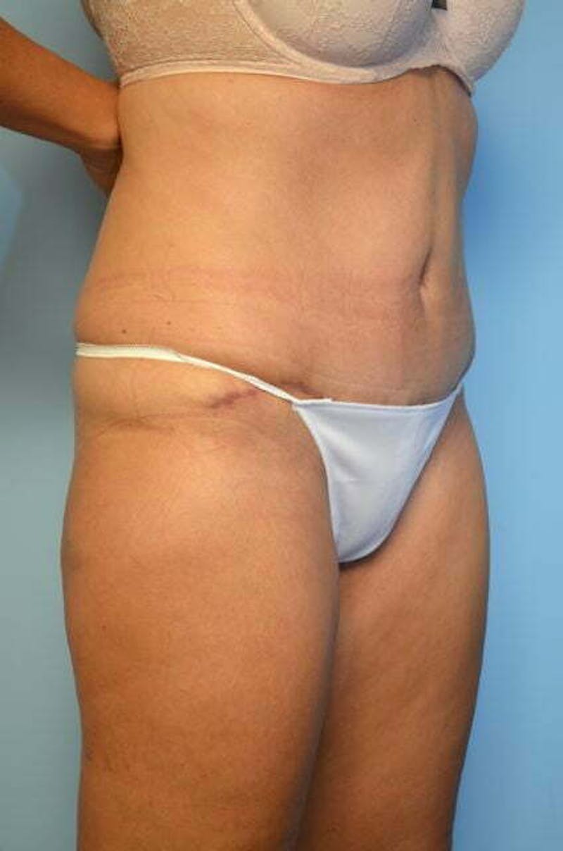Tummy Tuck Before & After Gallery - Patient 346349 - Image 4