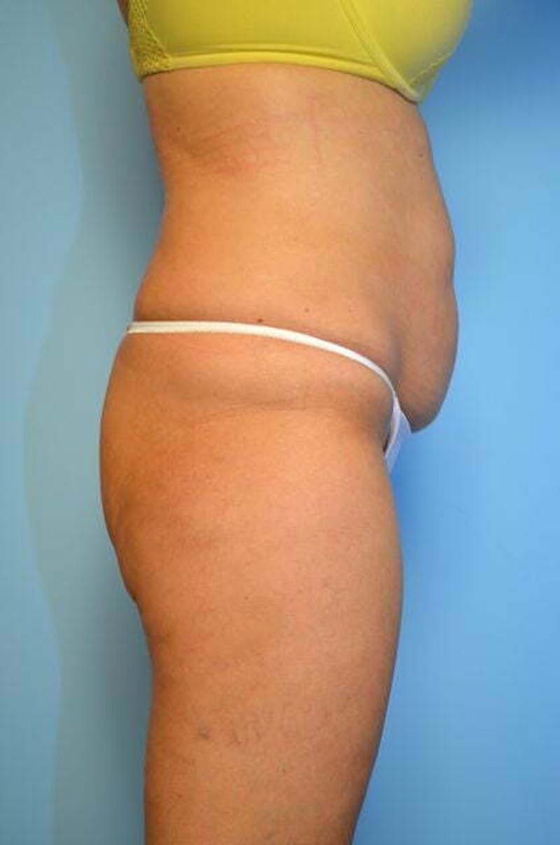 Tummy Tuck Before & After Gallery - Patient 346349 - Image 5