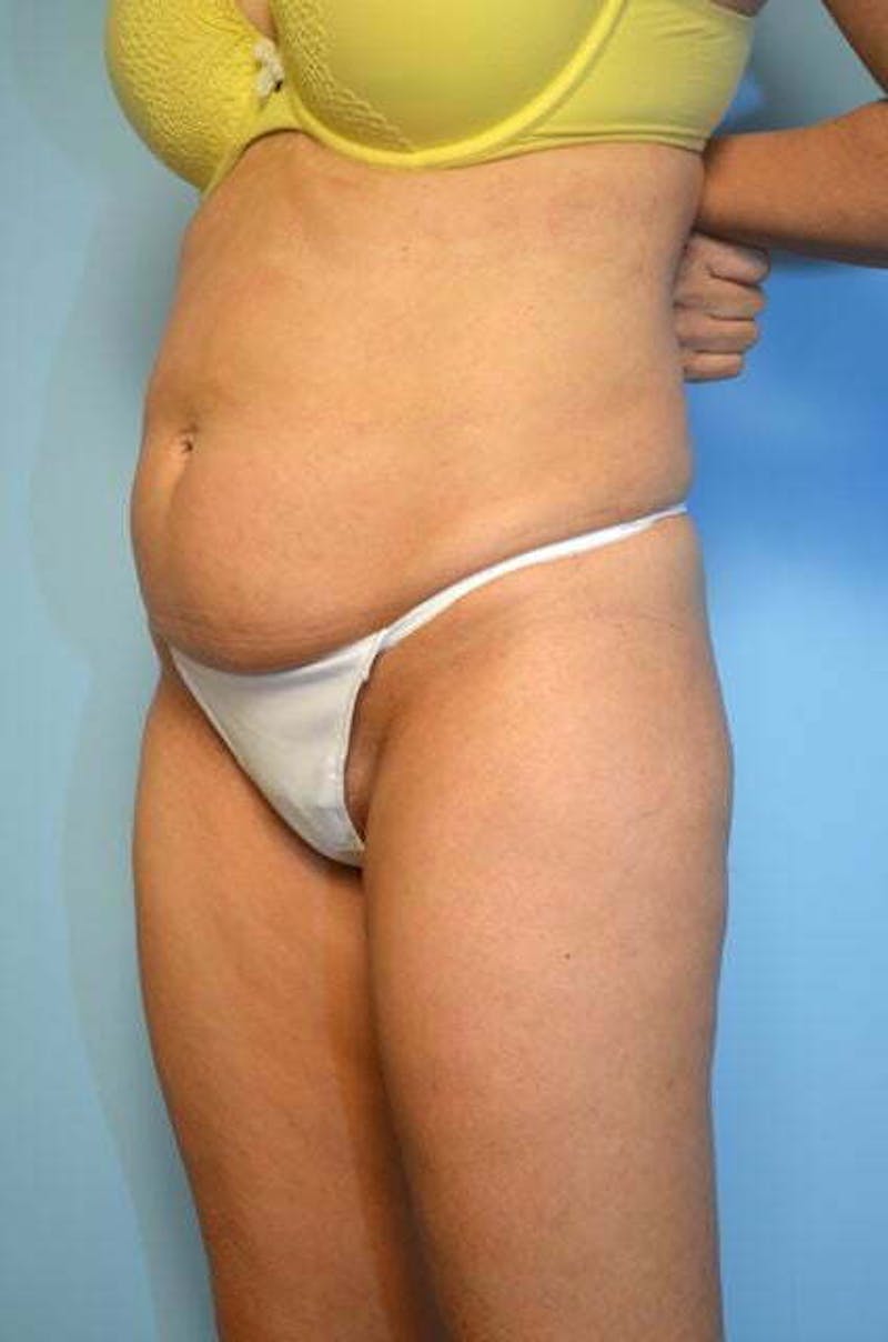 Tummy Tuck Before & After Gallery - Patient 346349 - Image 7