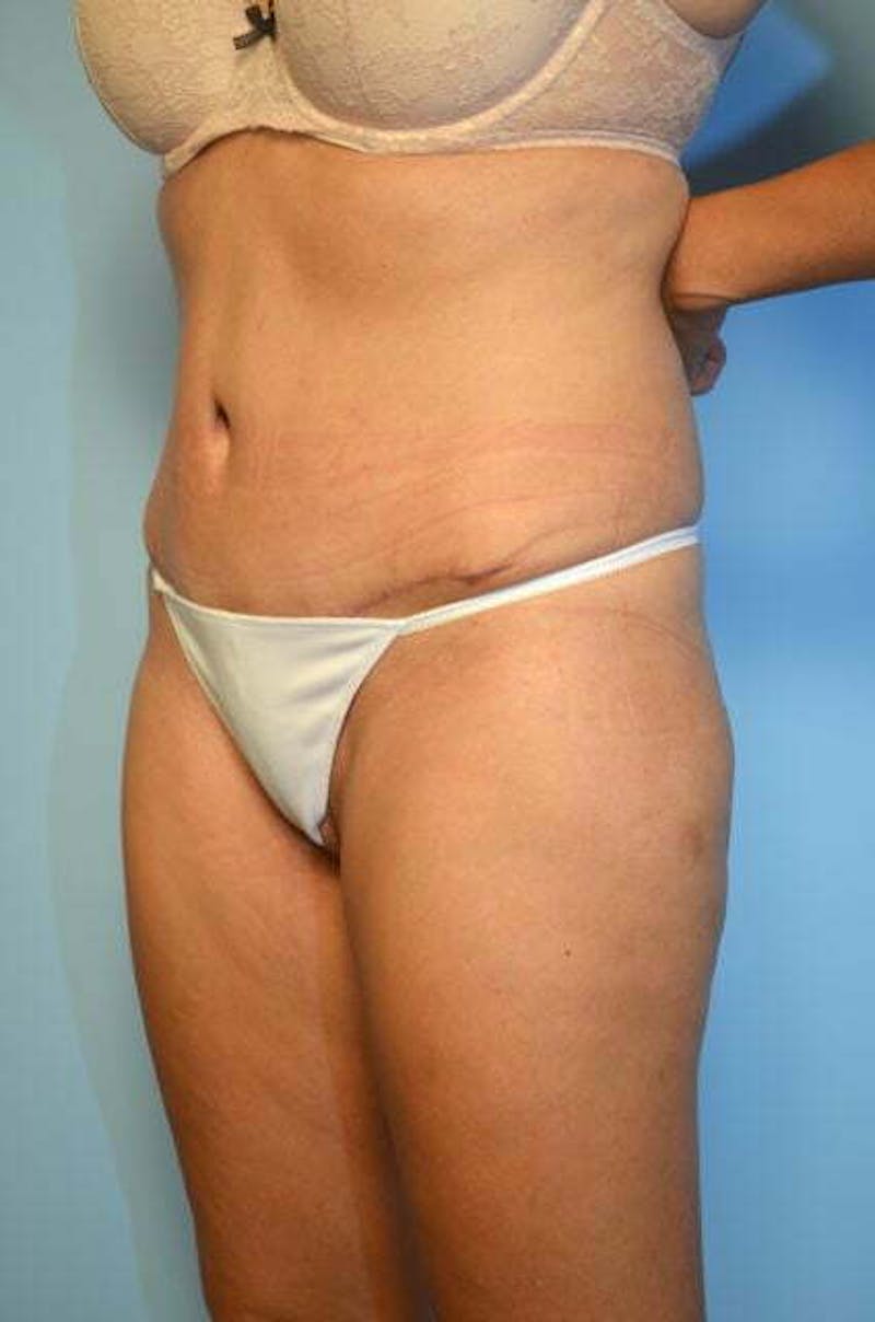 Tummy Tuck Before & After Gallery - Patient 346349 - Image 8