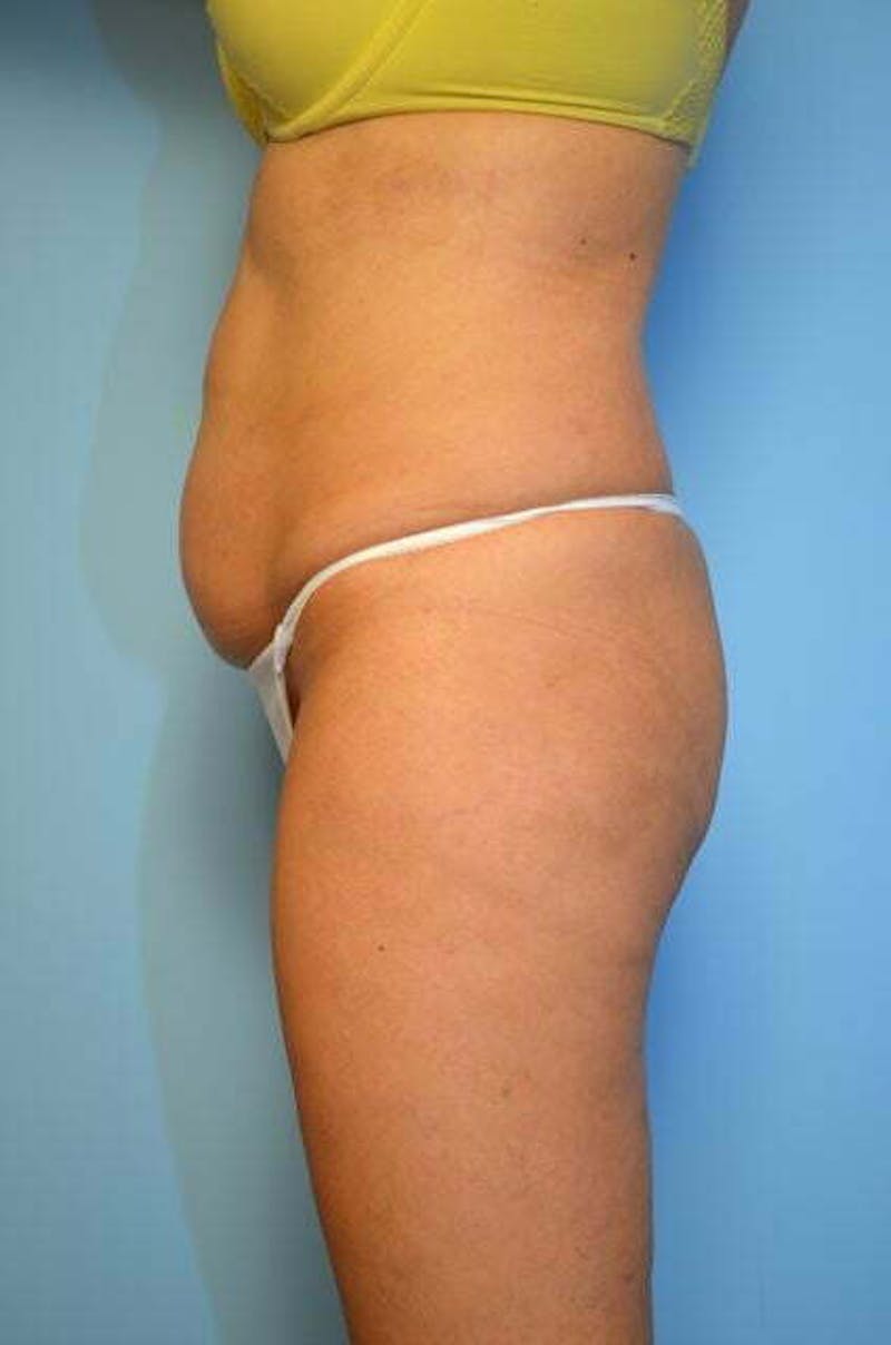 Tummy Tuck Before & After Gallery - Patient 346349 - Image 9