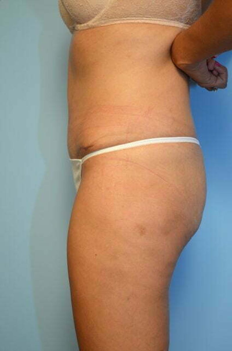 Tummy Tuck Before & After Gallery - Patient 346349 - Image 10