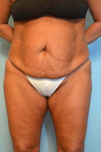 Liposuction Before & After Gallery - Patient 360731 - Image 1